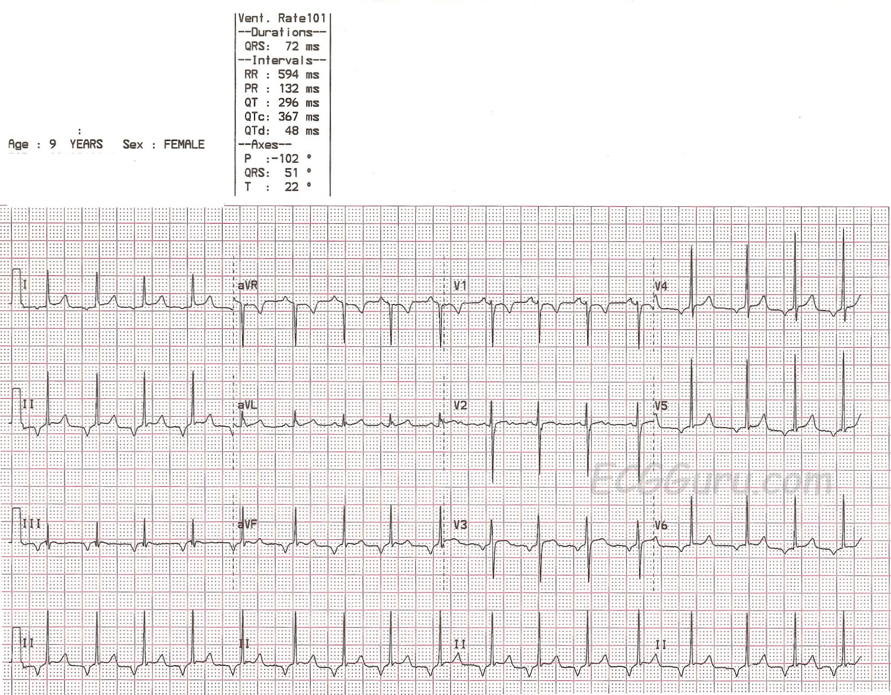 Pediatric ECG With Junctional Rhythm ECG Guru Instructor Resources